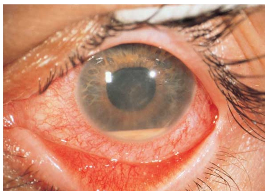 Clinical photograph of a painful left eye