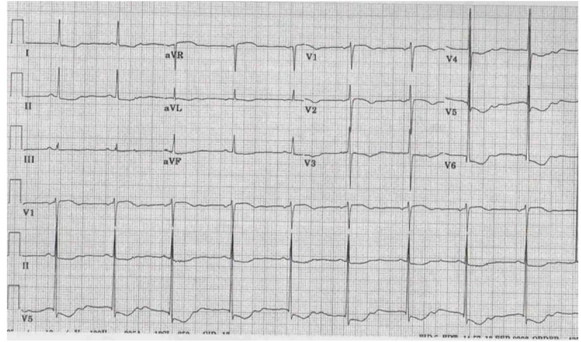 ECG for an 18-year-old after collapse