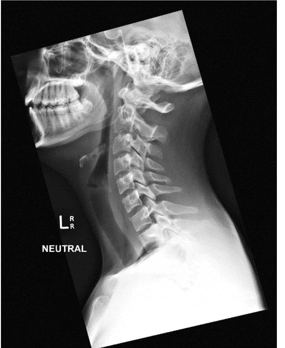 Lateral cervical spine X-ray after trampoline fall