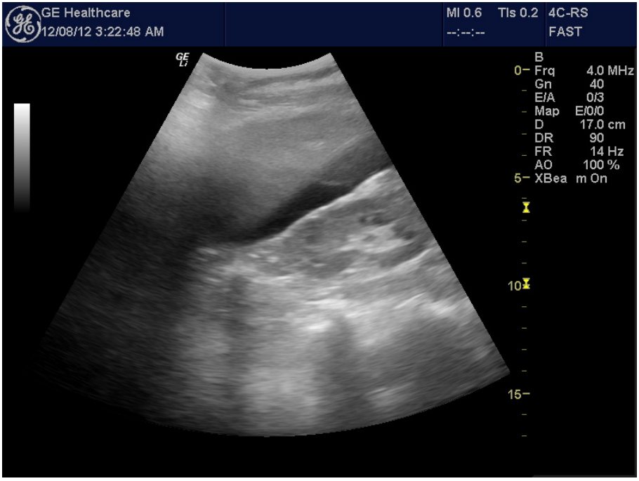 FAST ultrasound image in the right upper quadrant after high-speed motor vehicle trauma
