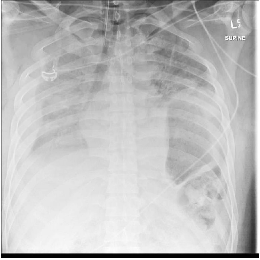 Supine chest X-ray after high-speed motor vehicle trauma