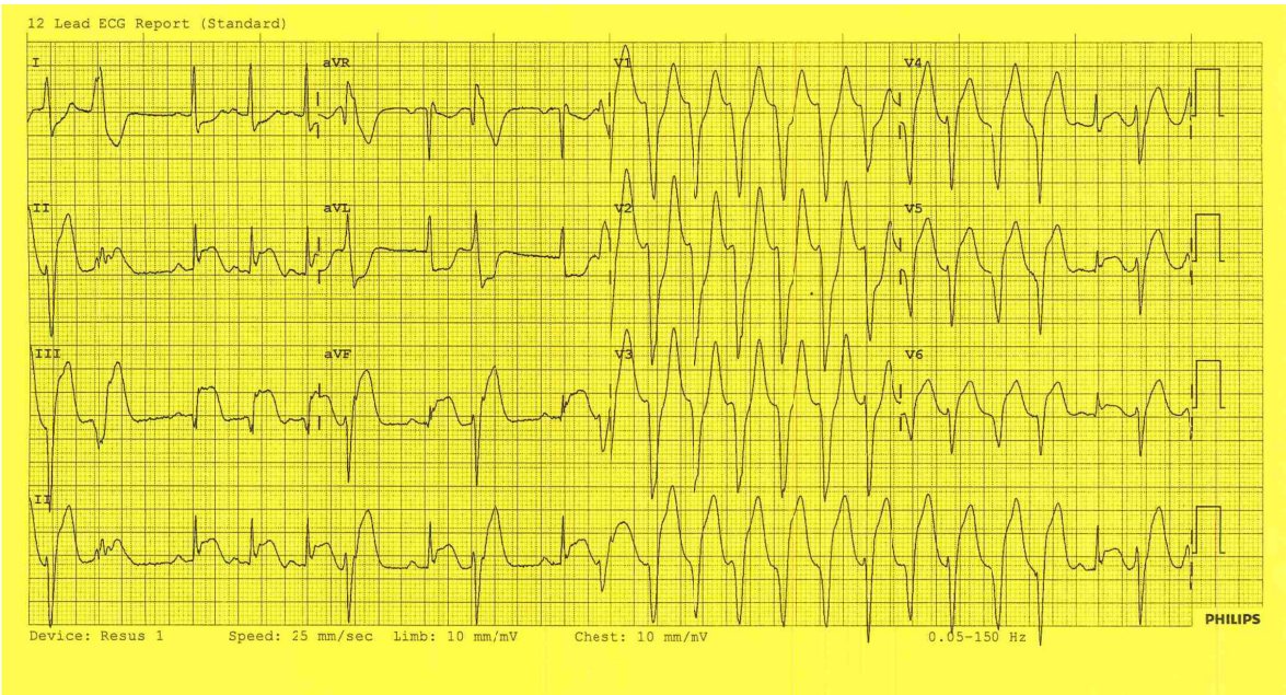 ECG for a patient with chest pain