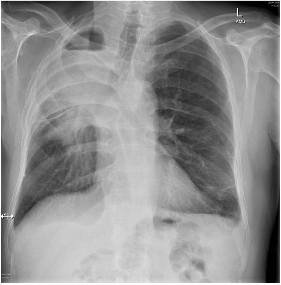 Chest X-ray for a patient with dyspnoea