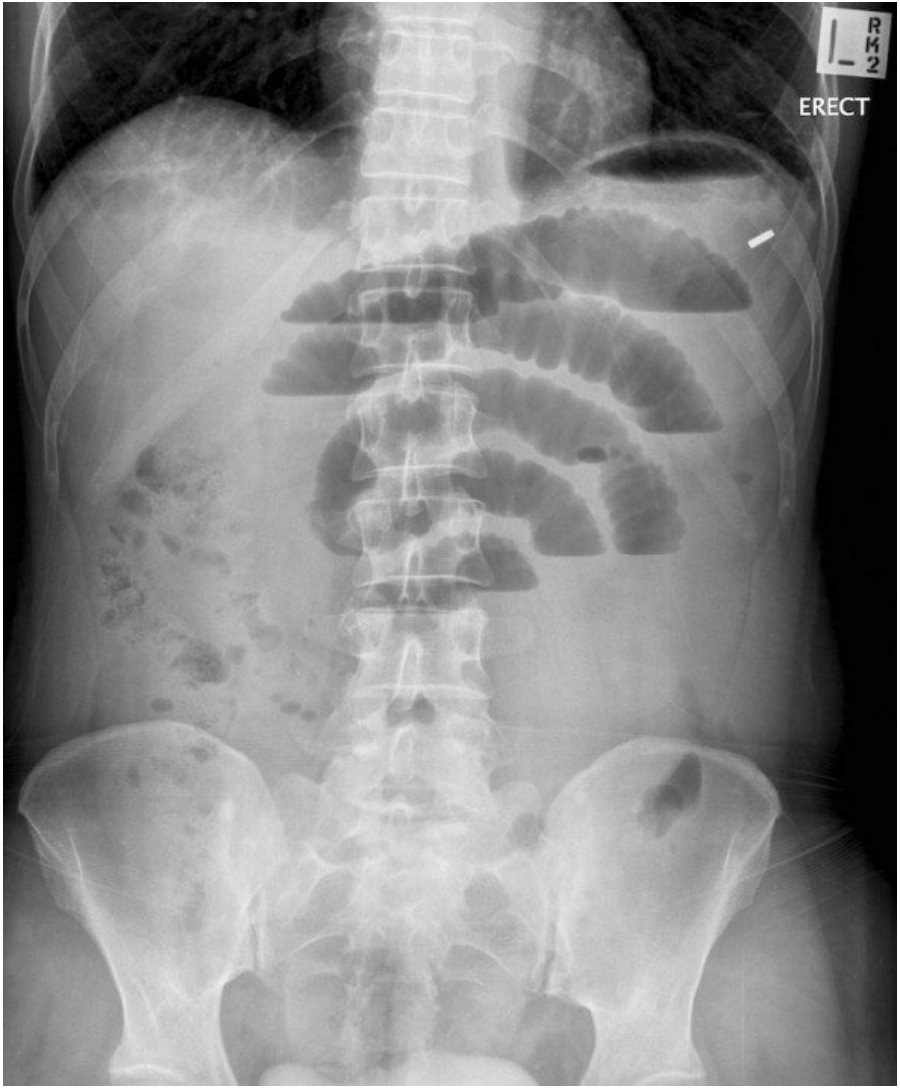 Erect abdominal X-ray for a patient with abdominal pain