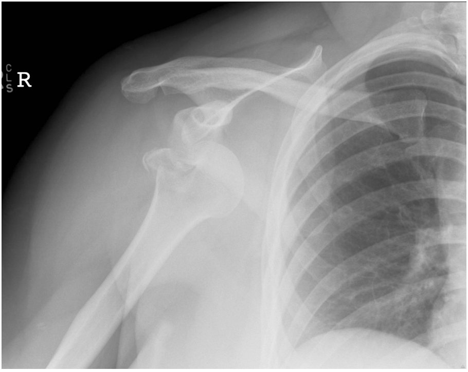 Right shoulder X-ray after a fall playing basketball