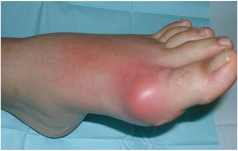 Clinical photograph of a painful swollen left foot