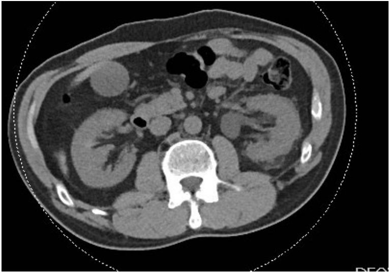 Axial CT abdomen image for left-sided abdominal pain