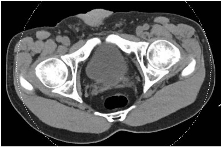 Axial CT pelvis image for left-sided abdominal pain