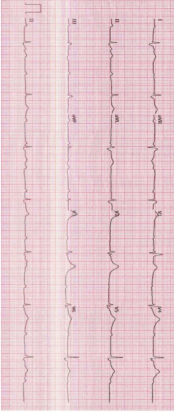 ECG for a patient with dizziness