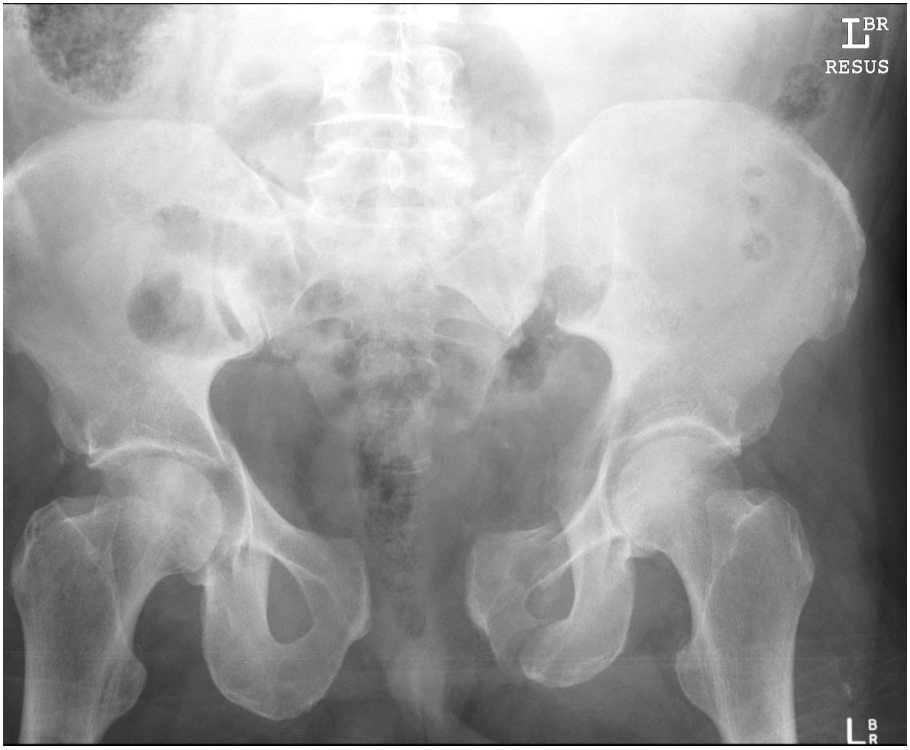 Pelvic X-ray after a fall from a horse