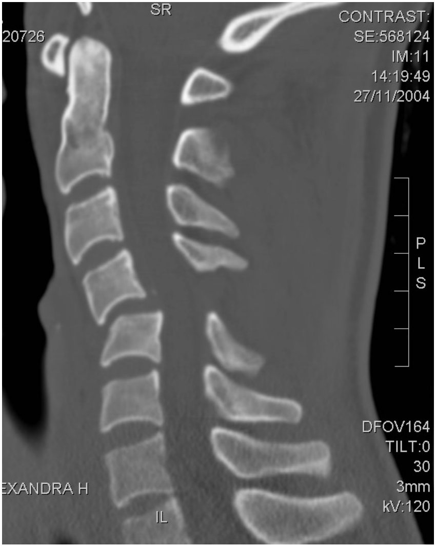 Sagittal CT cervical spine after fall onto head