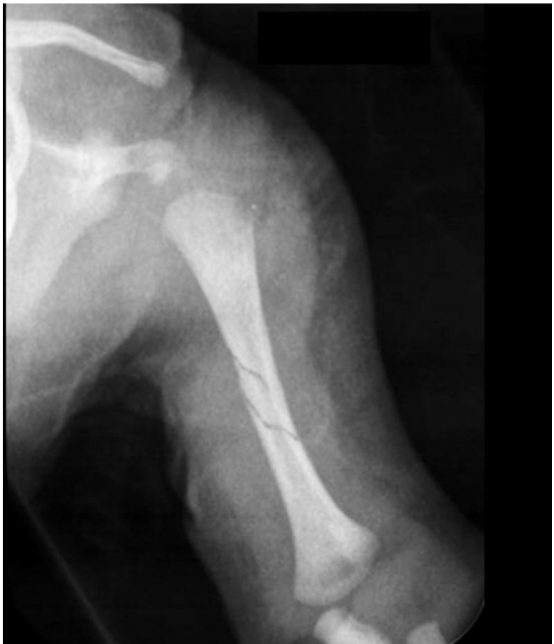 Left humerus X-ray for infant arm pain