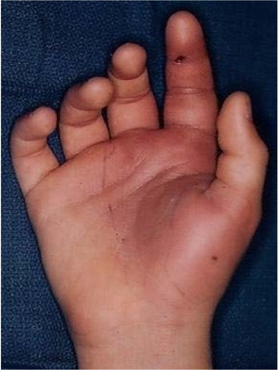 Clinical photograph of a child's right hand after finger injury