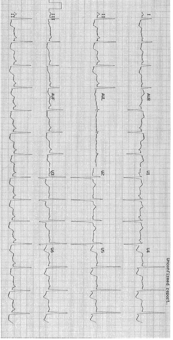 Post-ROSC ECG for interpretation