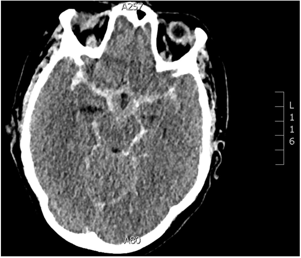 Non-contrast CT brain image for interpretation