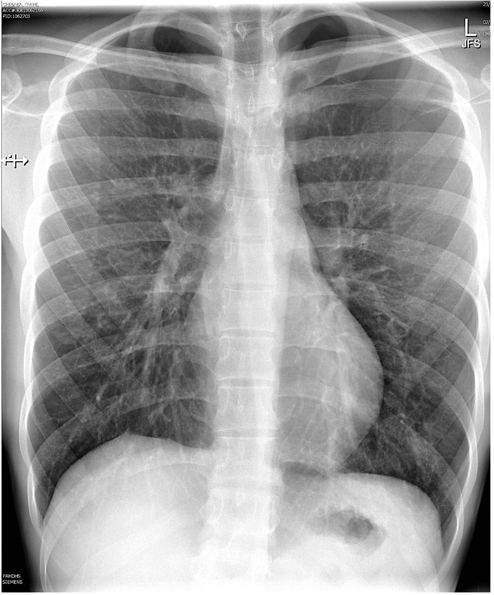 Chest X-ray for young adult with chest pain