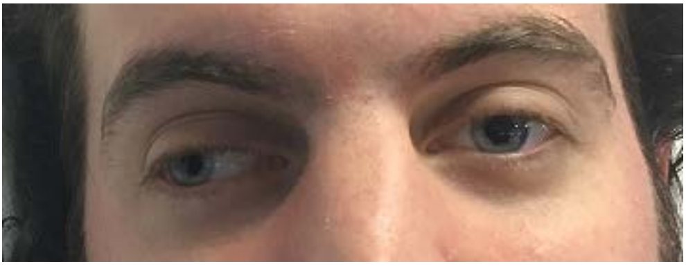 Clinical photograph after snakebite with double vision