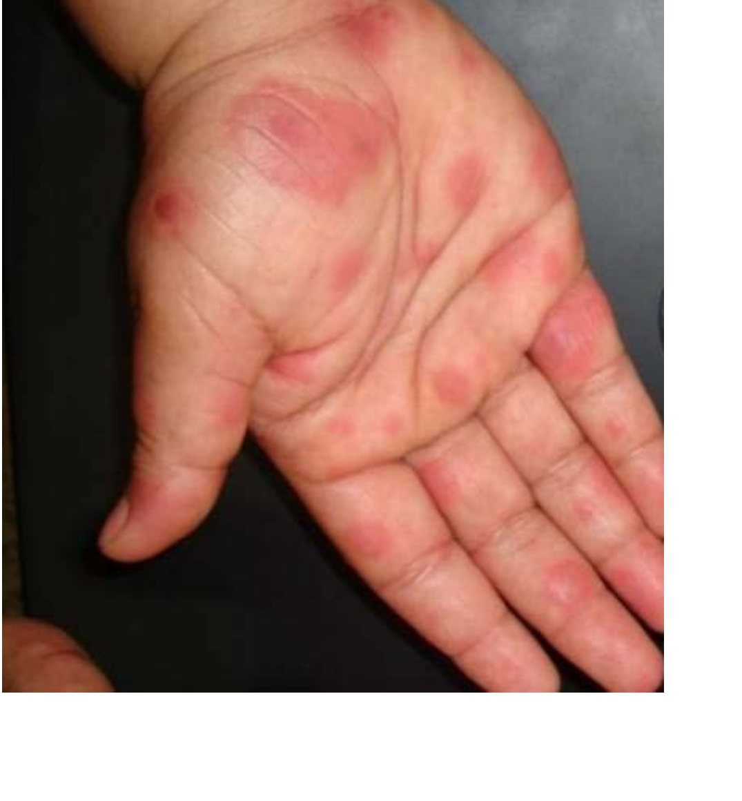 Clinical photograph of rash involving the palm