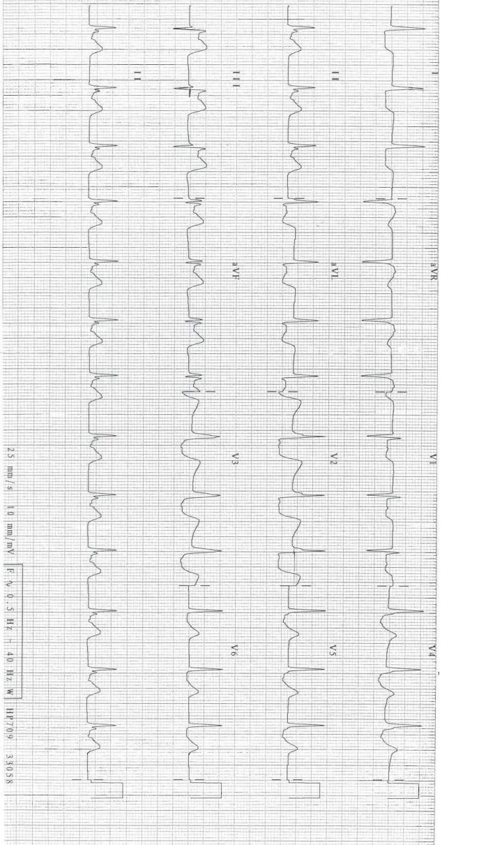 ECG for patient with chest pain and shock