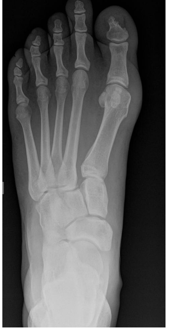 Left foot X-ray for re-presenting foot pain