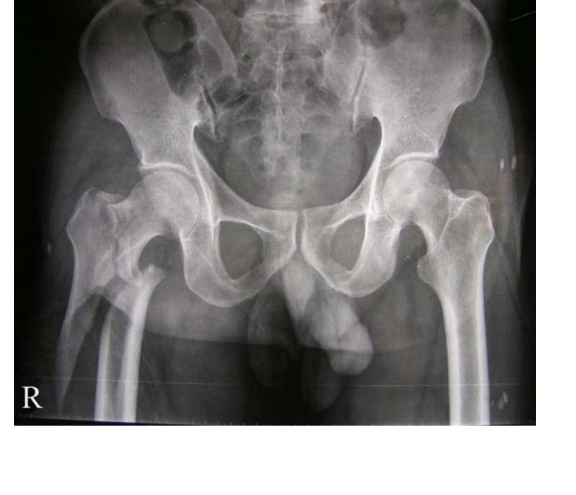 Pelvis X-ray after inpatient fall with hip pain