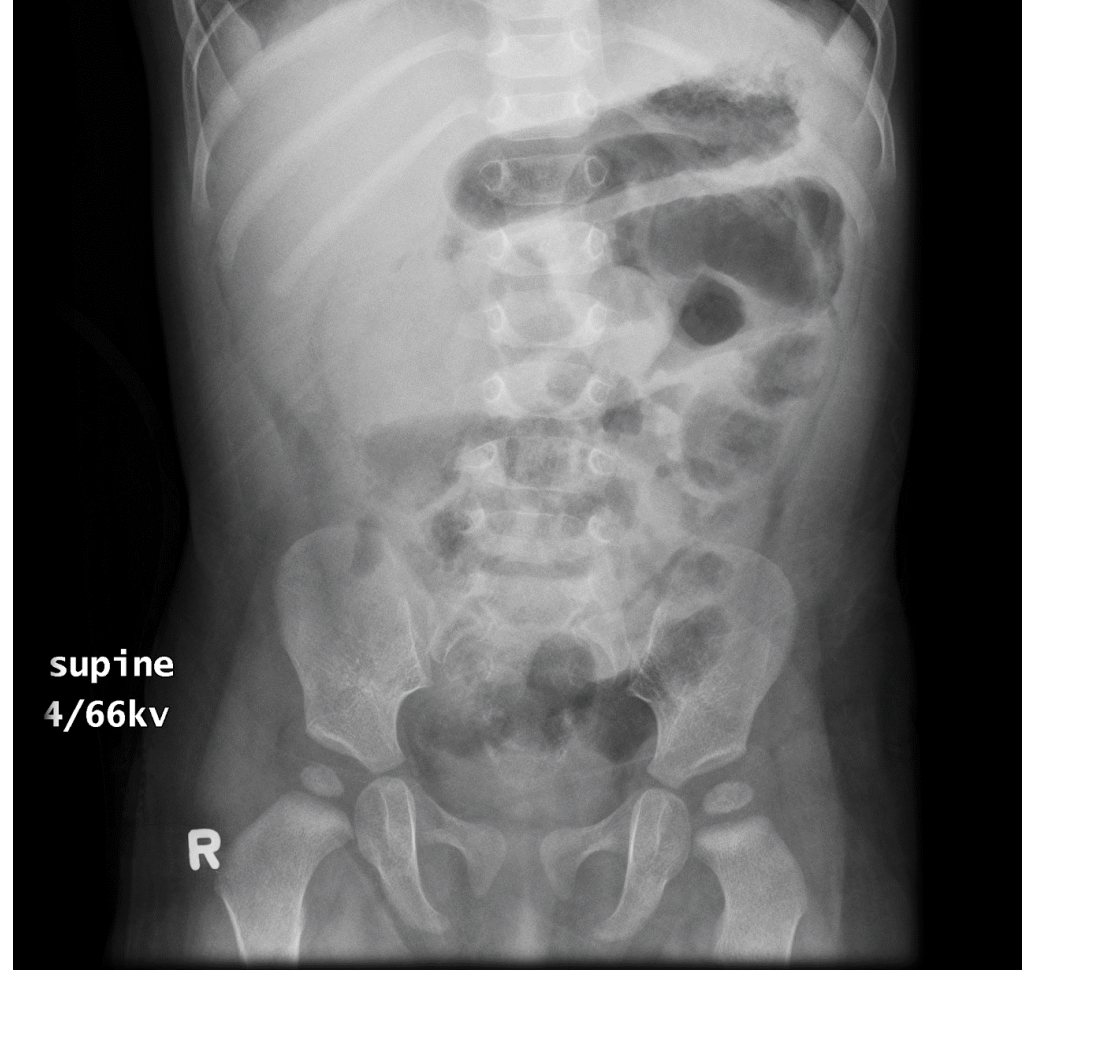 Abdominal X-ray for infant with abdominal pain and vomiting