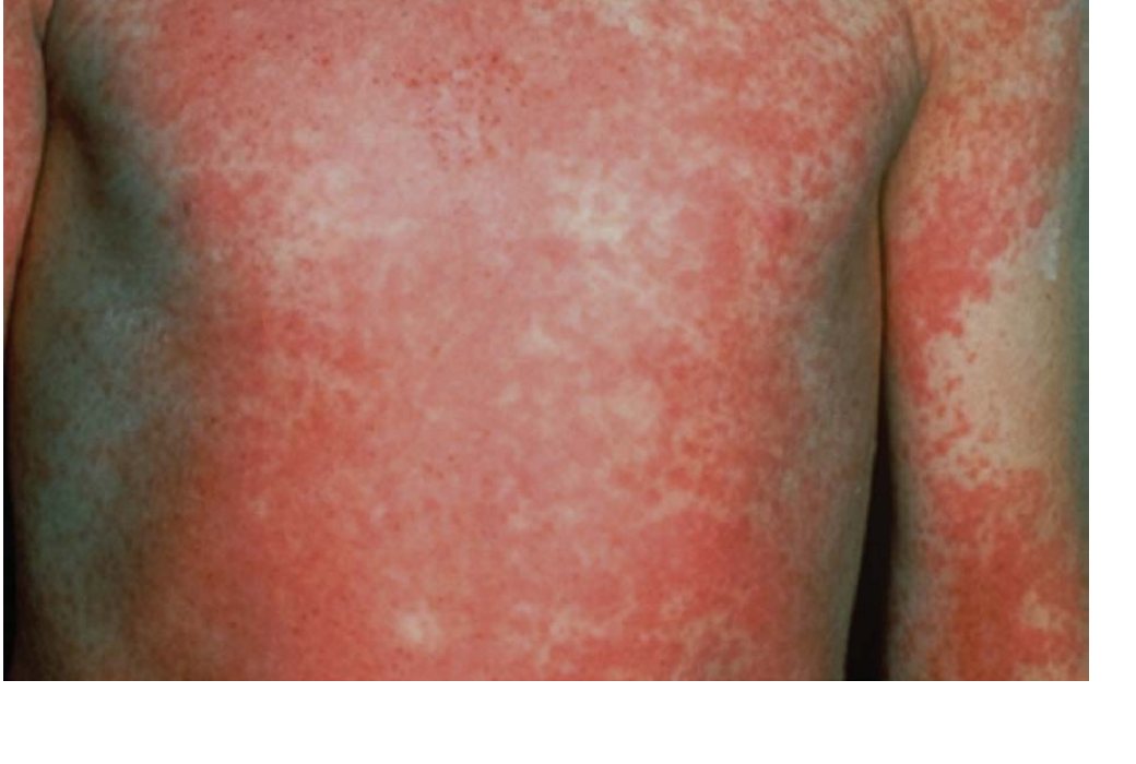 Clinical photograph of rash in child with fever and sore throat