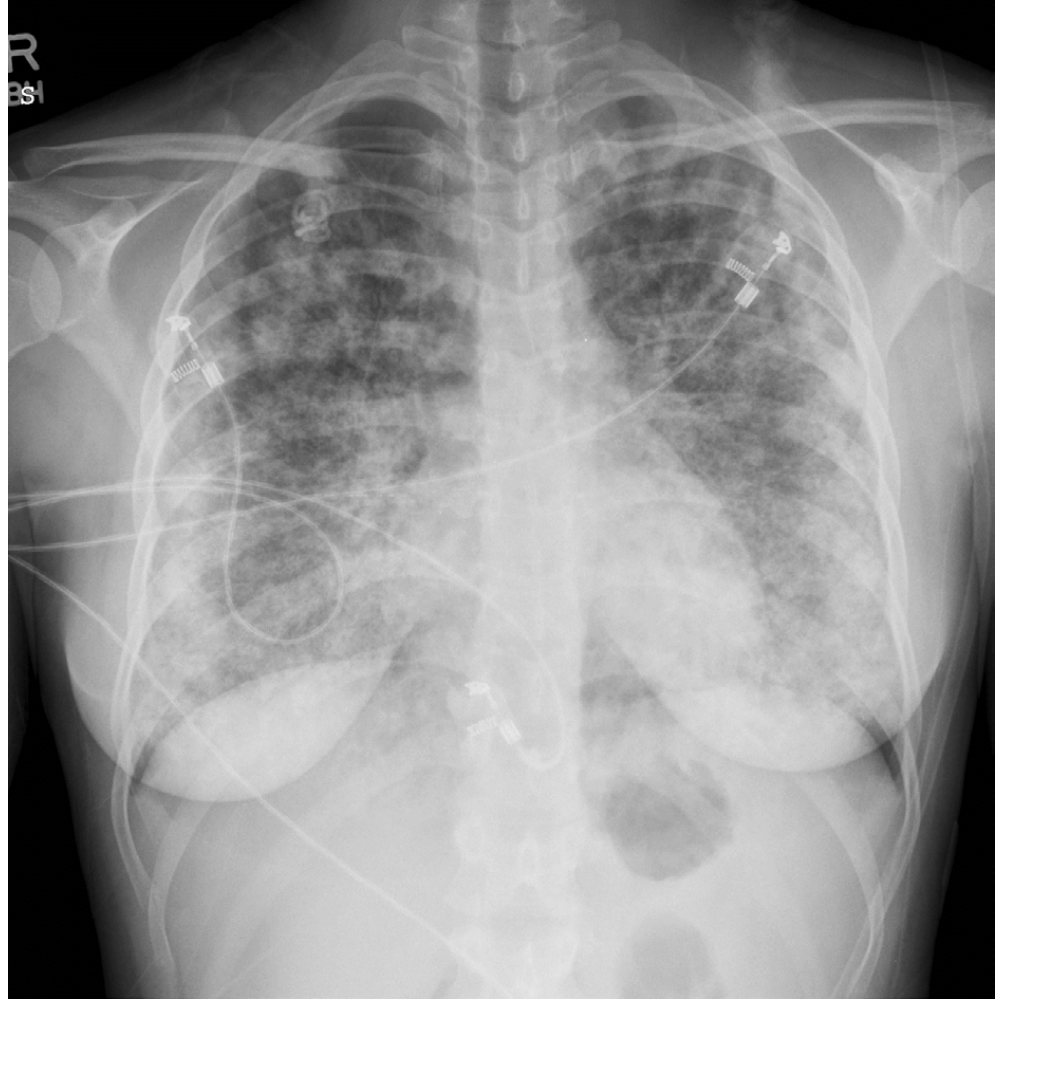 Chest X-ray for patient with severe shortness of breath