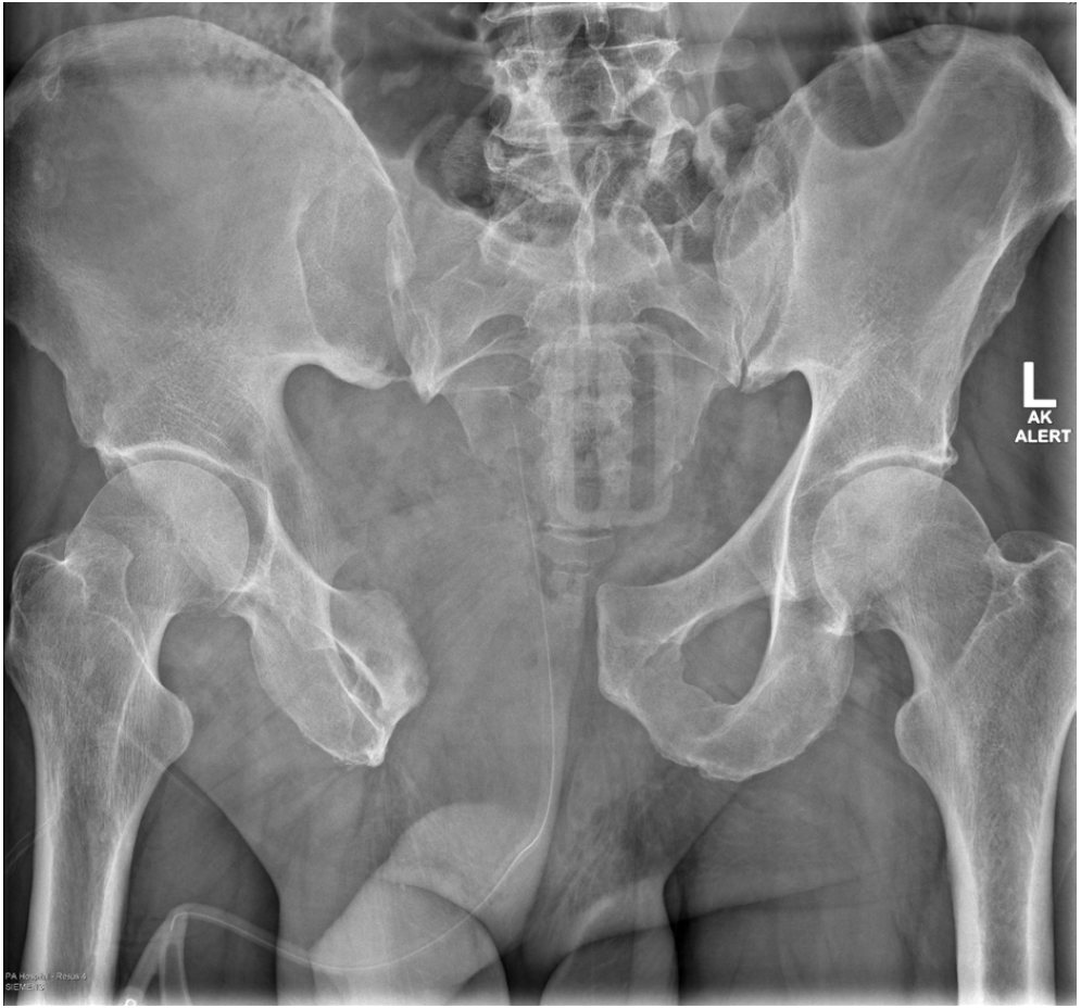 Pelvic X-ray after fall from horse