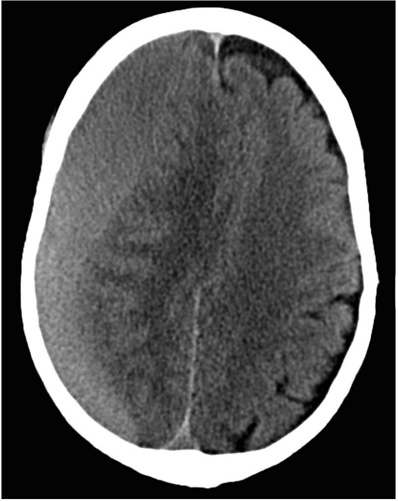 CT brain for patient with worsening confusion on warfarin