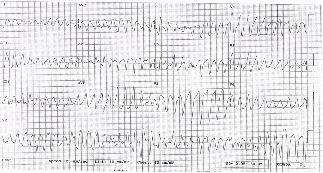 ECG during prolonged dizziness