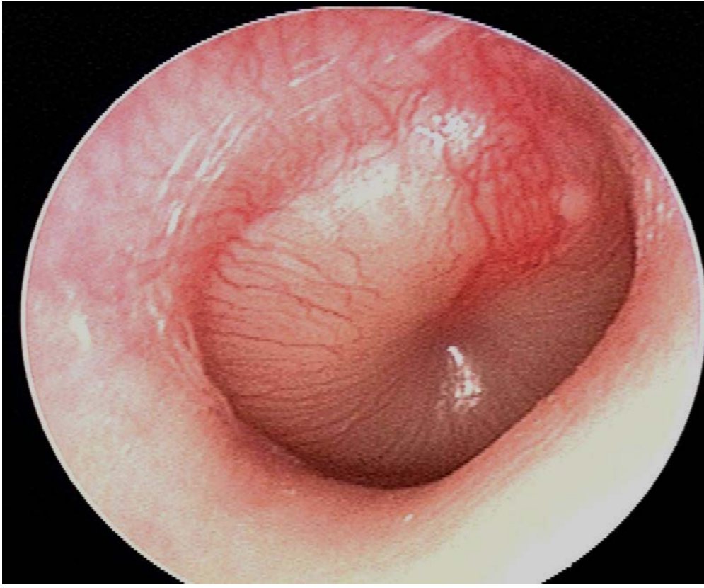 Otoscopy photograph for child with ear pain