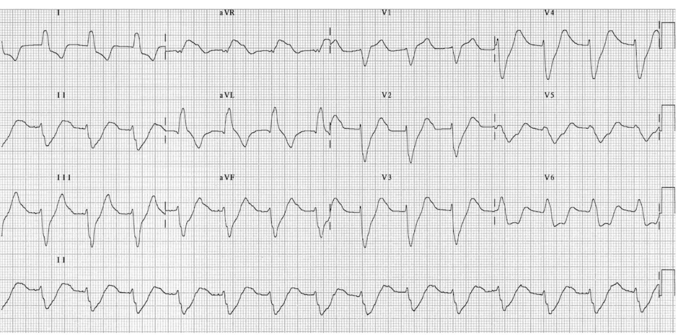 ECG for patient with missed dialysis and lethargy
