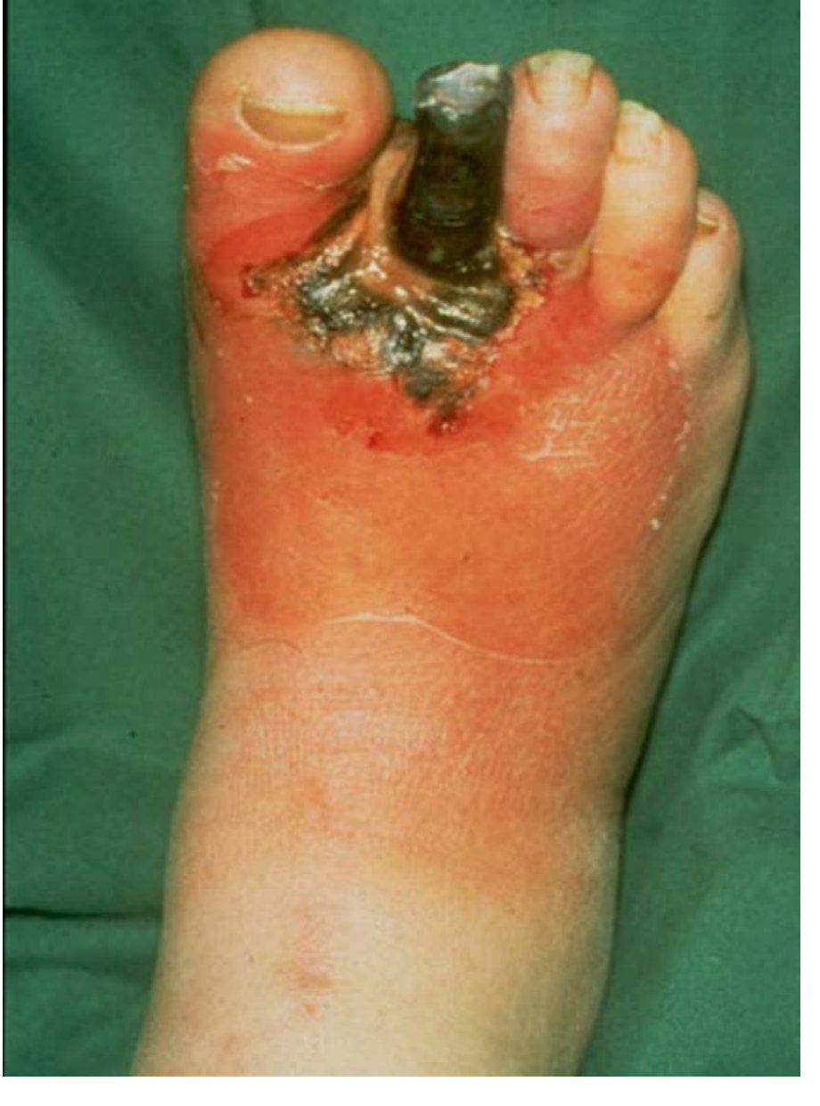 Clinical photograph of painful red foot