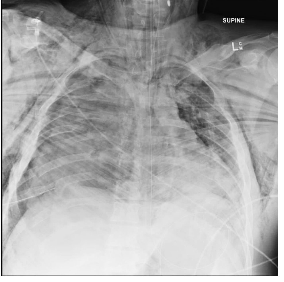 Chest X-ray after high-speed motor vehicle crash