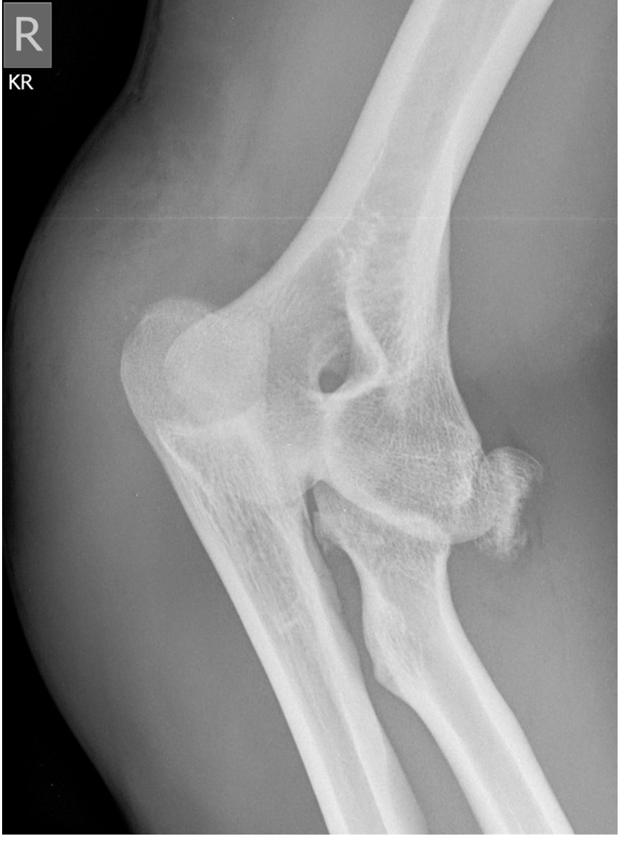 AP right elbow X-ray after fall