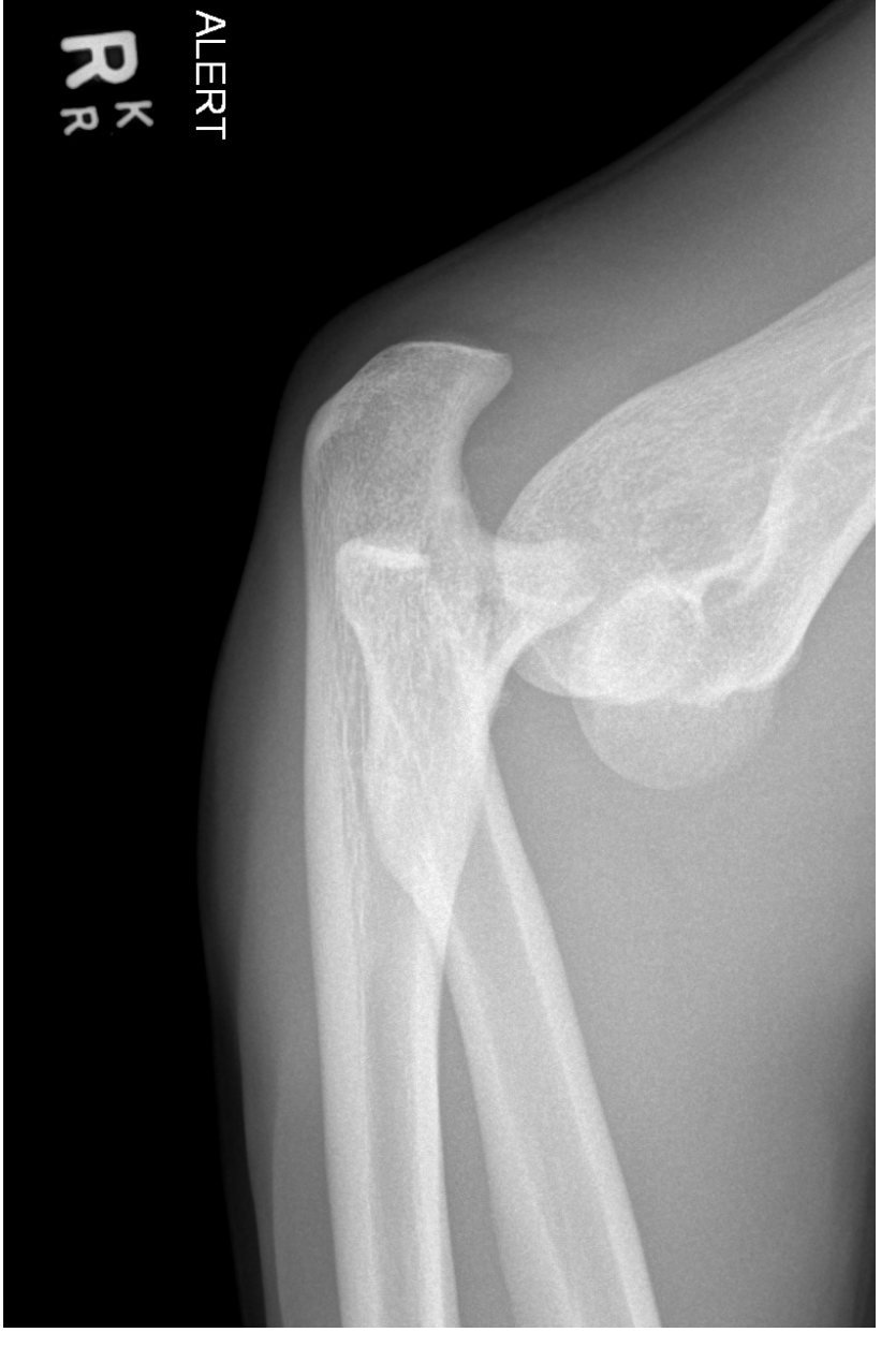 Lateral right elbow X-ray after fall