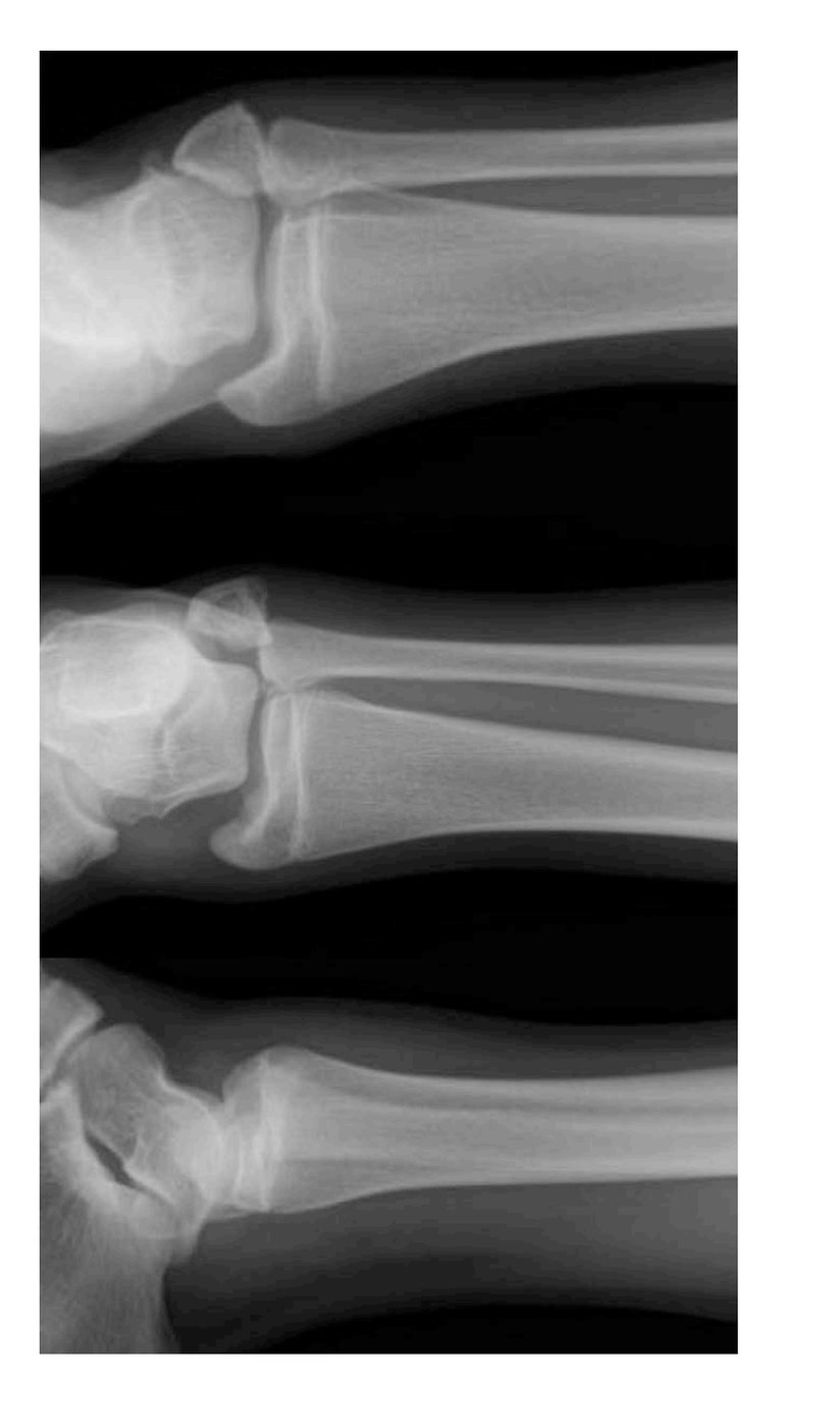 Right ankle X-rays after football injury
