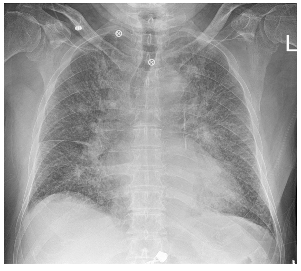 Chest X-ray after clinical deterioration