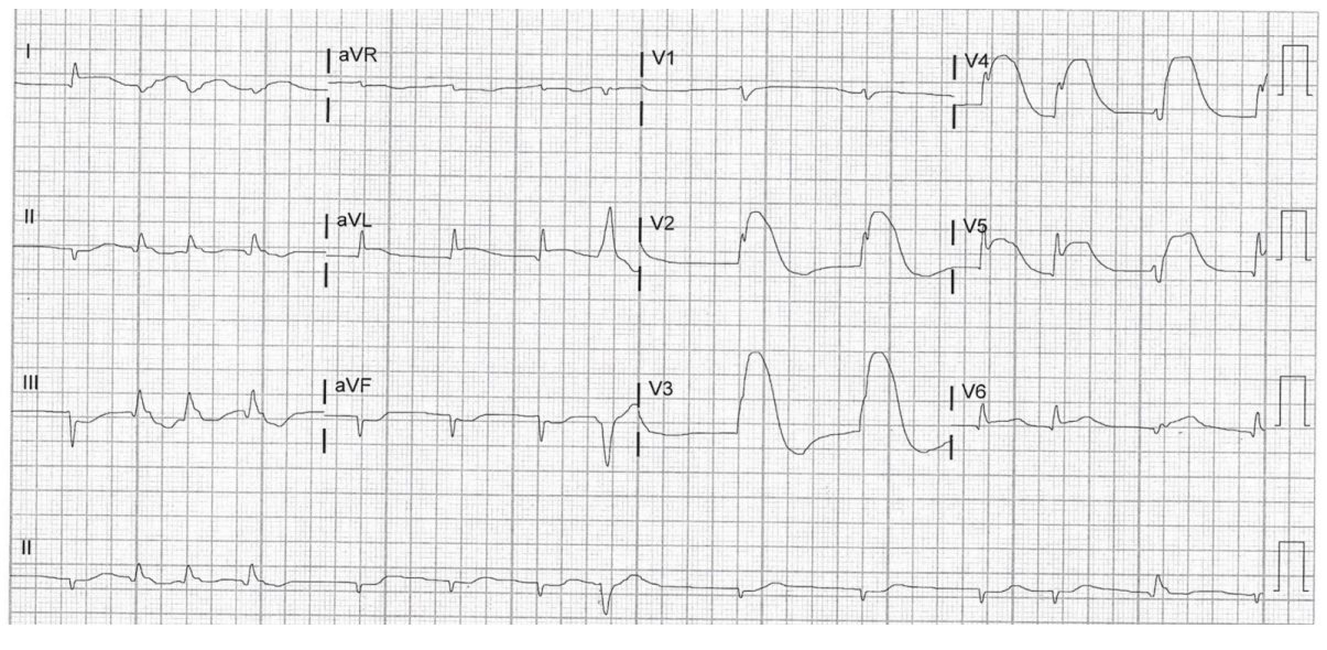 ECG for patient with chest pain