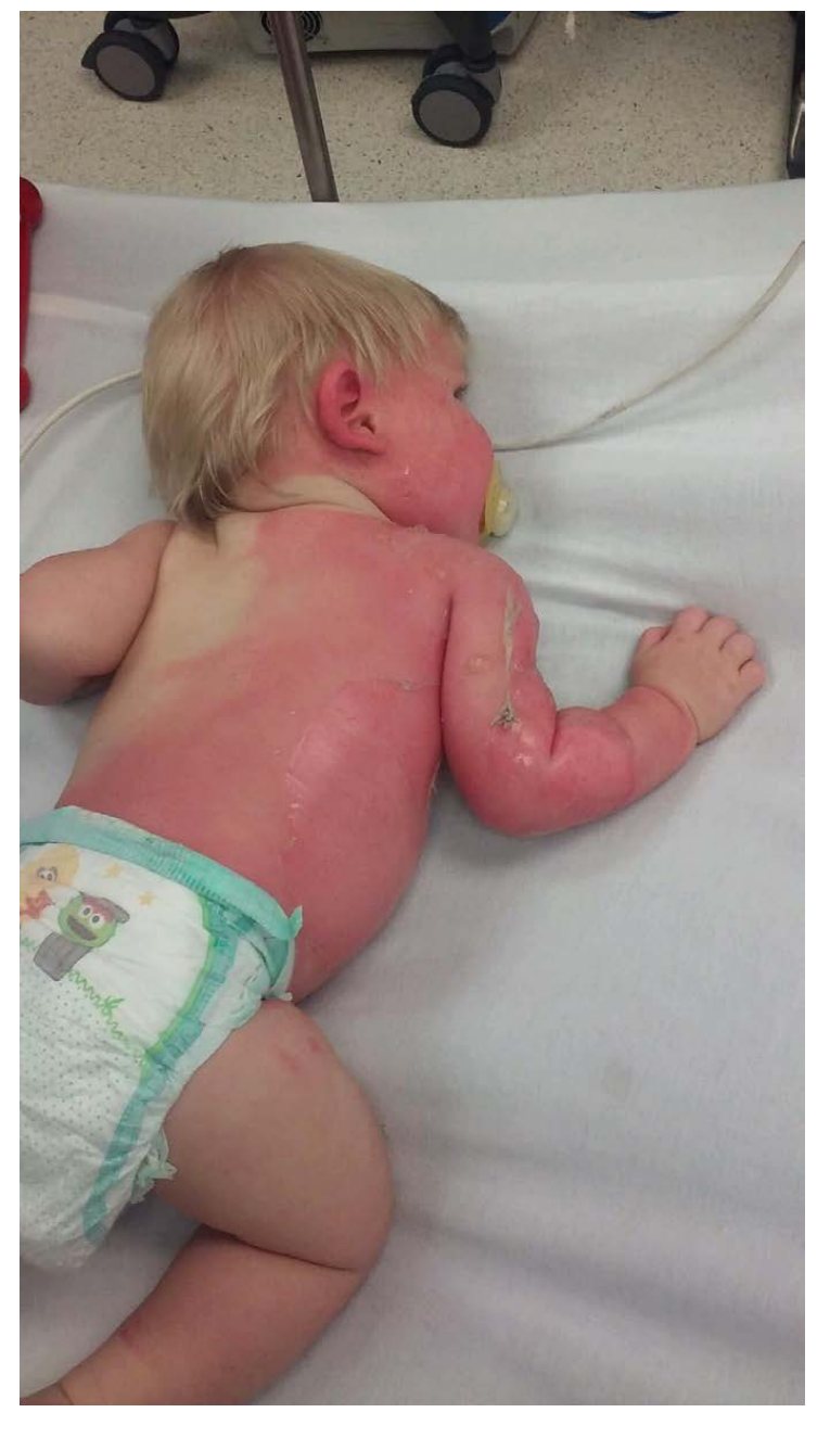 Clinical photograph after hot-water injury in a child