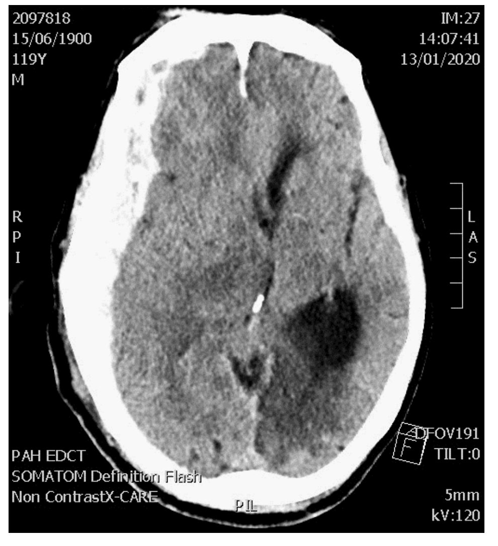 CT brain for unconscious older man