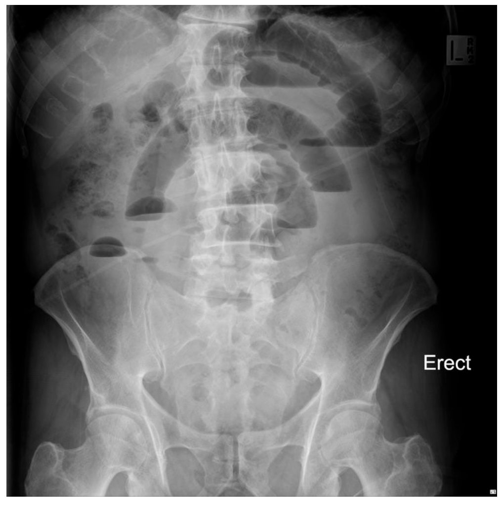 Erect abdominal X-ray for abdominal pain and vomiting
