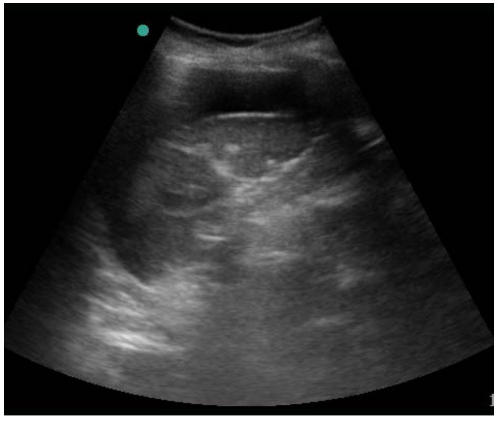 FAST left upper quadrant image after bicycle fall