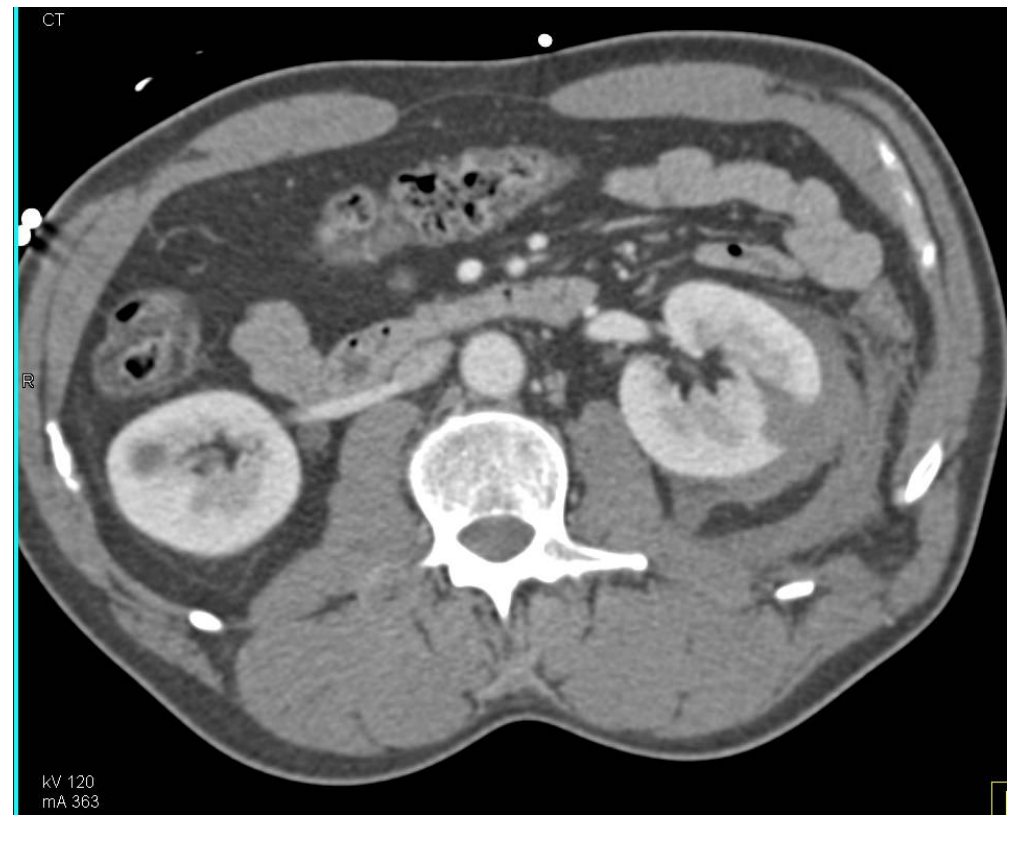 CT abdomen slice after penetrating thoracic trauma