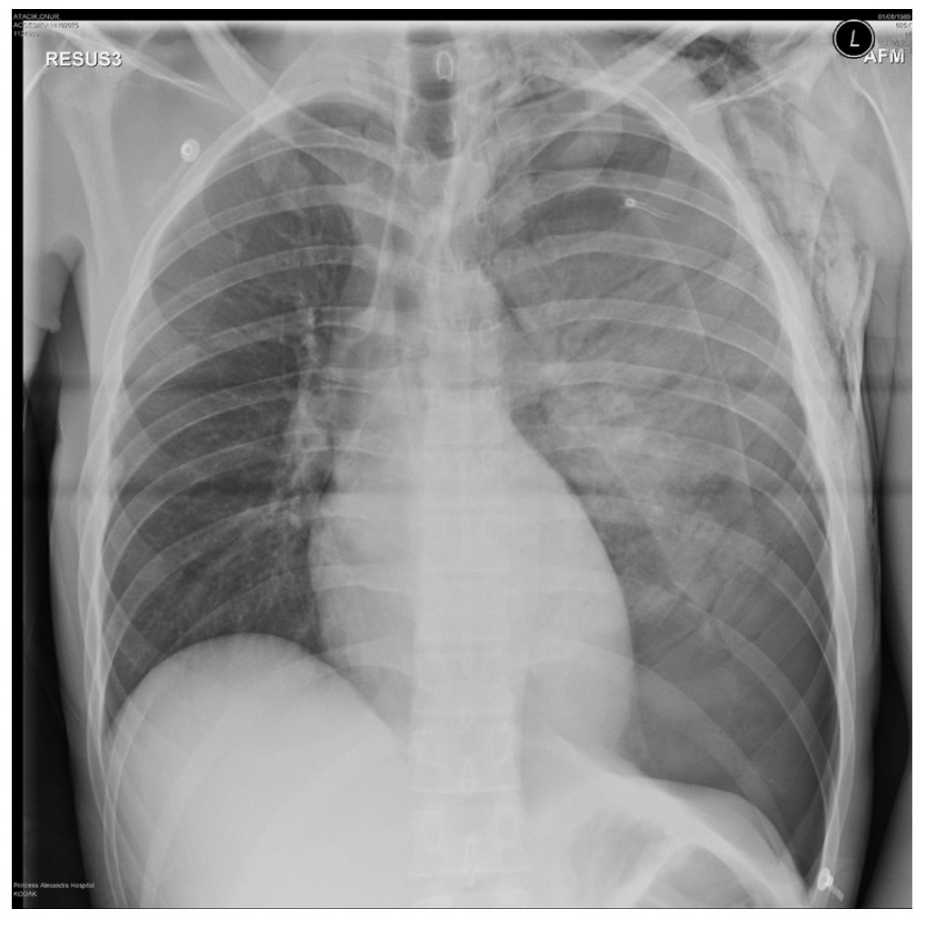 Chest X-ray after penetrating thoracic trauma
