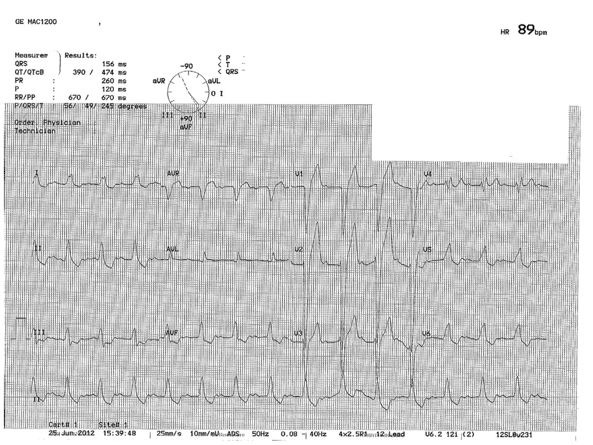 ECG for older man after syncope