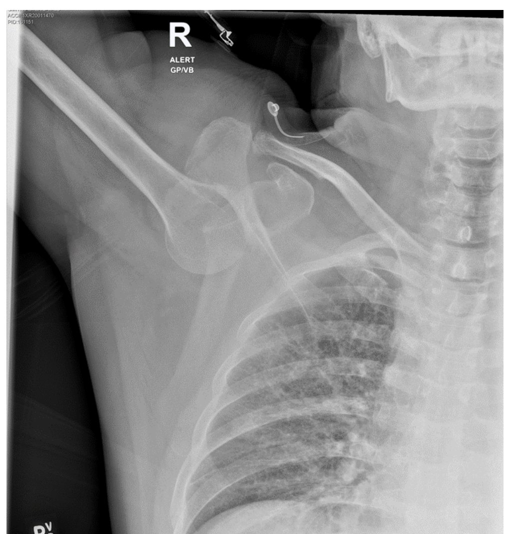 Right shoulder X-ray after motorcycle crash