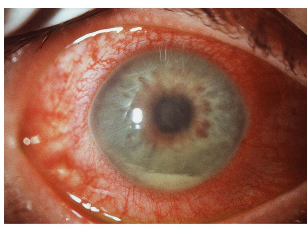 Right eye photograph for painful red eye