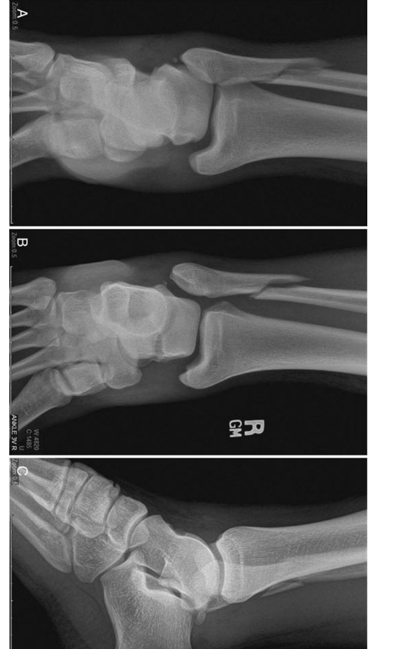 Right ankle X-ray after isolated ankle injury